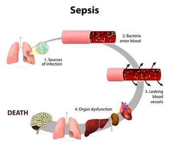 A diagram of sepsis is shown.