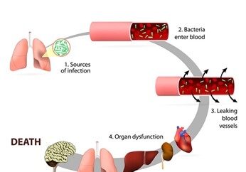 A diagram of sepsis is shown.